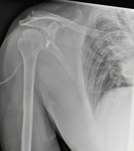 Schulterluxation Www ortho hart schulterluxation-www-ortho-hart